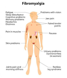 fibromyalgia arthritis