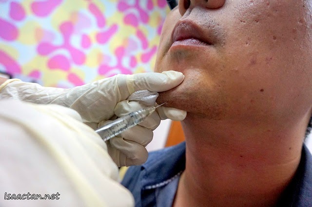 On top of the MesoLipo fat melting procedure, I went for a very minor filler injection on my 'chinless' chin On top of the MesoLipo fat melting procedure, I went for a very minor filler injection on my 'chinless' chin