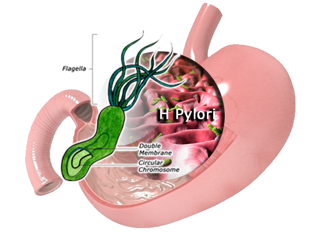 Prepare for Medical Exams : Treatment for Helicobacter pylori infection