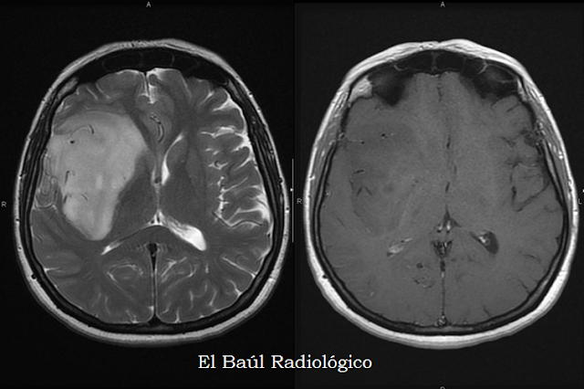 prostata con area pseudonodulare in t2 e stir