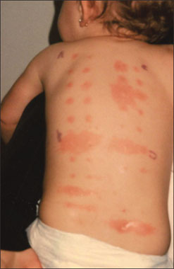 allergy test results scale #11