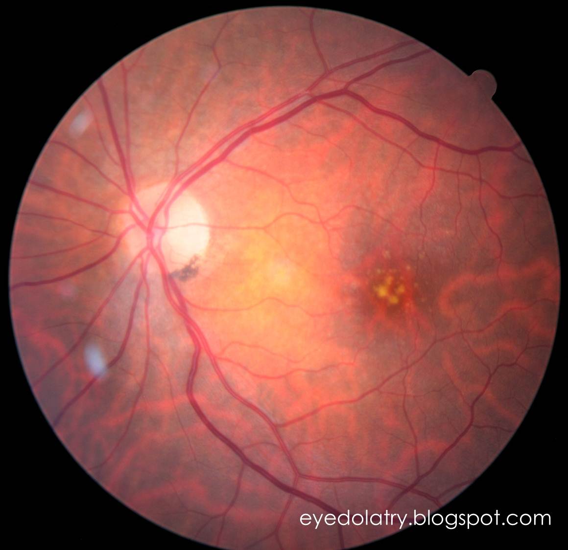 Retinal Photography II Eyedolatry