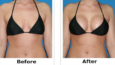 silicone nos seios antes e depois silicone nos seios antes e depois
