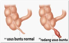 defination radang usus buntu http://www.udan.name defination radang usus buntu http://www.udan.name