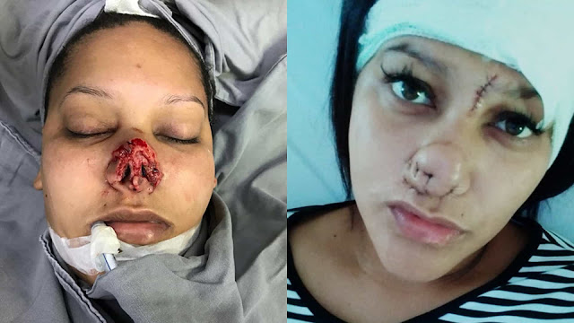 Mulher que teve nariz arrancado pelo ex terá de fazer 15 cirurgias