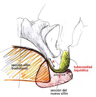 Fisioterapia Real Dolor En El Glúteo Al Estar Mucho Tiempo Sentado