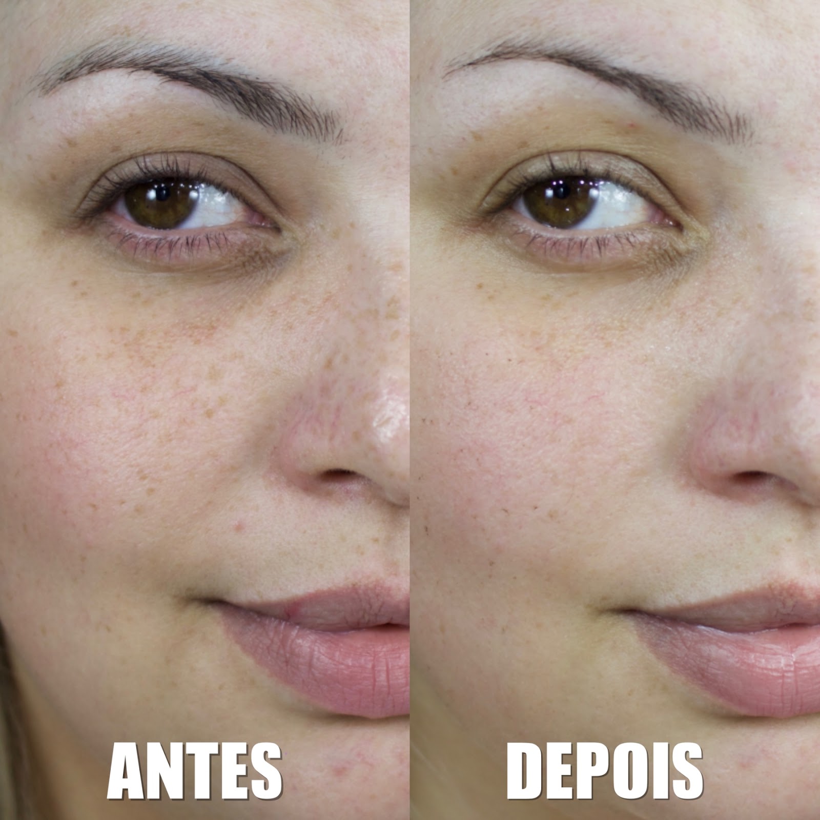 Fashion MiMi: Veja Como Ficou: Fiz 1 Sessão de Luz Pulsada para Clarear