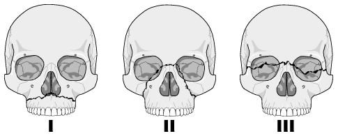 Facial fracture classification congratulate, the Remarkable, facial fracture classification really. opinion