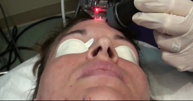 Metode menggunakan laser untuk perawatan wajah