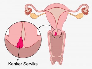 https://3.bp.blogspot.com/-faM_qeVEGlQ/WNTY1M78Q3I/AAAAAAAAAaI/sCBAQUQHgtgycv4jt4NsQdIt4UVgiwqtACLcB/s1600/kanker%2Bovarium.jpg