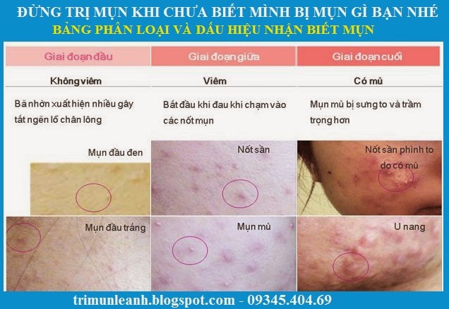 mặt nạ trị mụn trứng cá tại nhà mặt nạ trị mụn trứng cá tại nhà