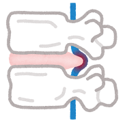 椎間板ヘルニアのイラスト