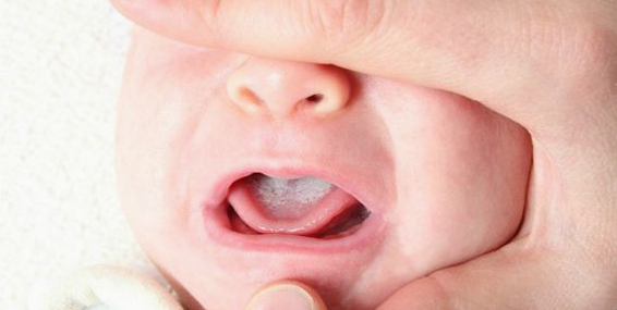 Thrush In Babies Mouth Home Remedies Thrush In Babies Mouth Home Remedies