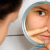 Remove Black Heads at your home