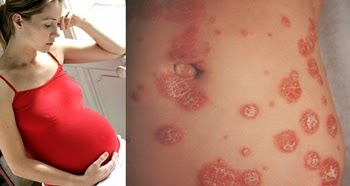 Cara Pengobatan Psoriasis Pada Ibu Hamil Cara Pengobatan Psoriasis Pada Ibu Hamil