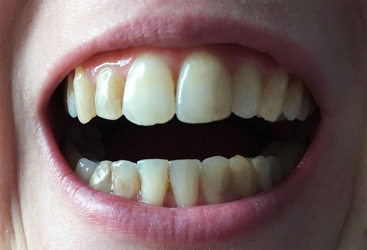 Orthodontie adulte bouche en chantier La fin du port de