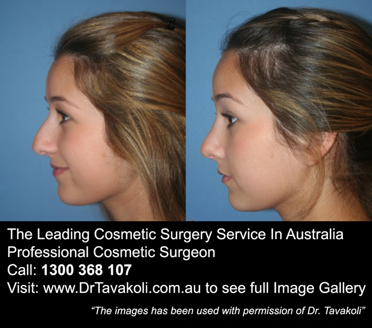 Nose Job Pain After The Leading Cosmetic Surgery Service In Australia