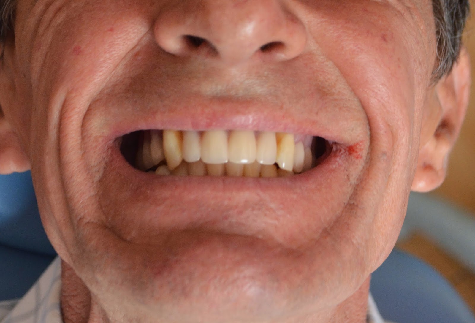 Odontología Especializada: Placas Totales (removibles) Estabilizados ...