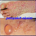 obat eksim yg di minum thumbnail