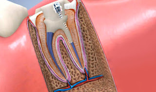 traitement de canal dentaire
