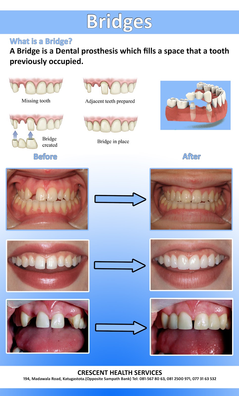 Dentistry and Medicine Free Download Crown, Bridges and Veneer Wall Chart (Poster)
