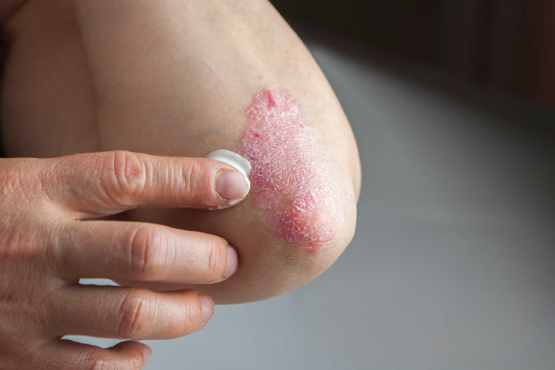 You're upping your risk of psoriasis 12 Ways Smoking Cigarettes Ruins Your Looks