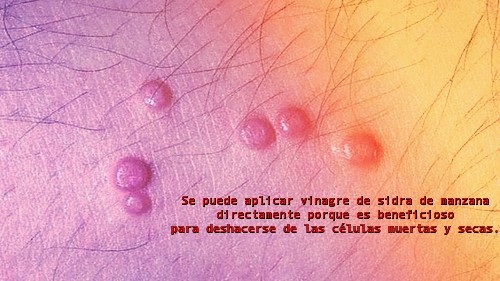 como eliminar verrugas en el ano en hombres como eliminar verrugas en el ano en hombres