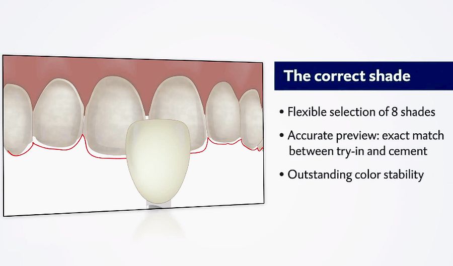 DENTAL MATERIALS Veneer cementing with added value the allnew