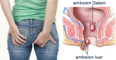 Foto Harga Obat tTadisional Wasir Di Apotik Ambejoss Denature