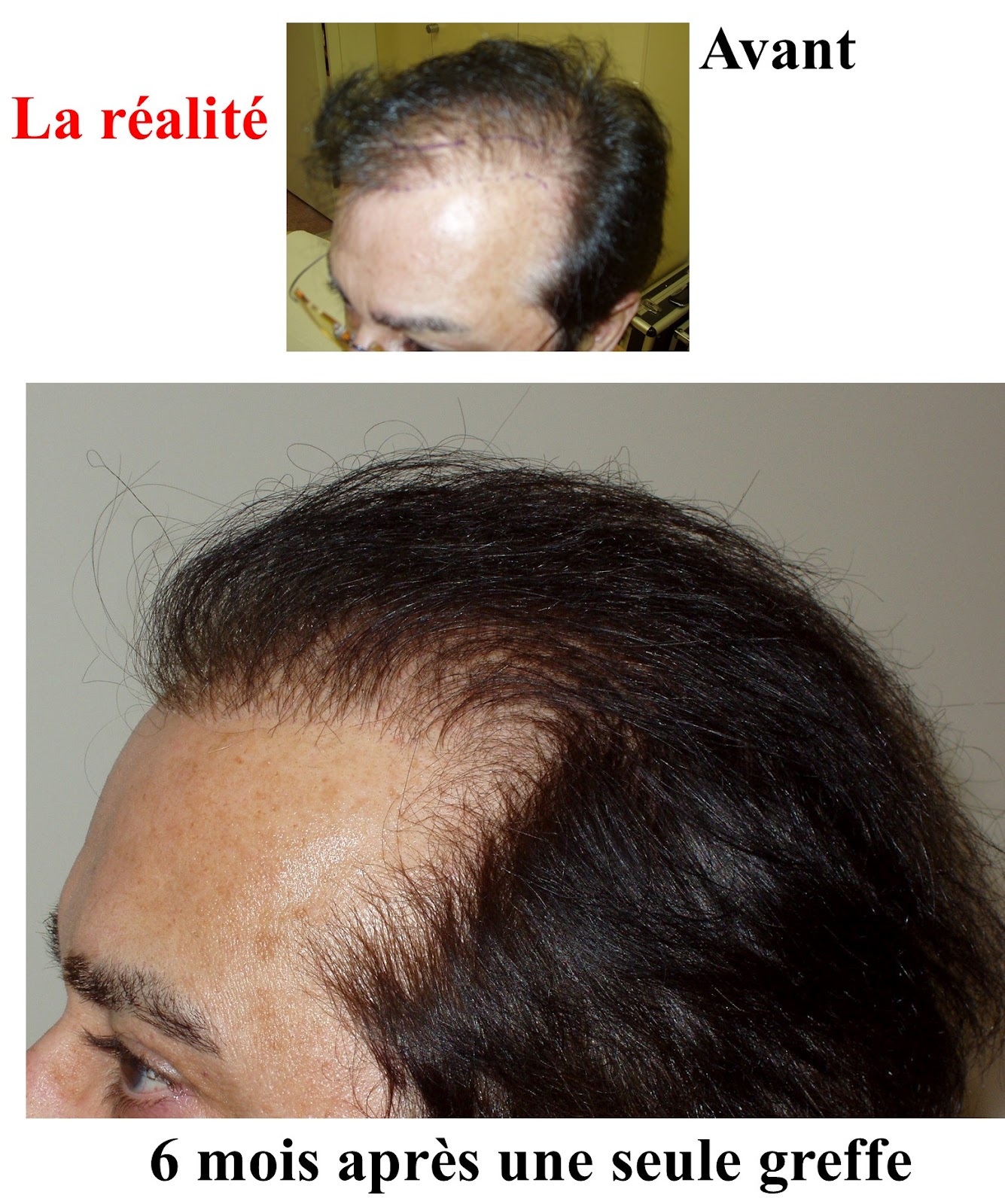 Greffe de cheveux en turquie - le blog de hair-for-life