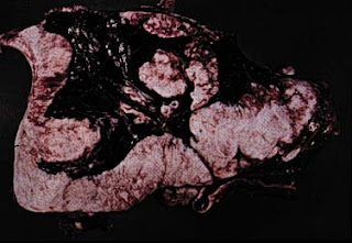 With the intention to fully empathise the human relationship betwixt asbestosis too Mesothelio Mesothelioma Article - While Asbestosis And Mesothelioma Share Influenza A virus subtype H5N1 Common Cause