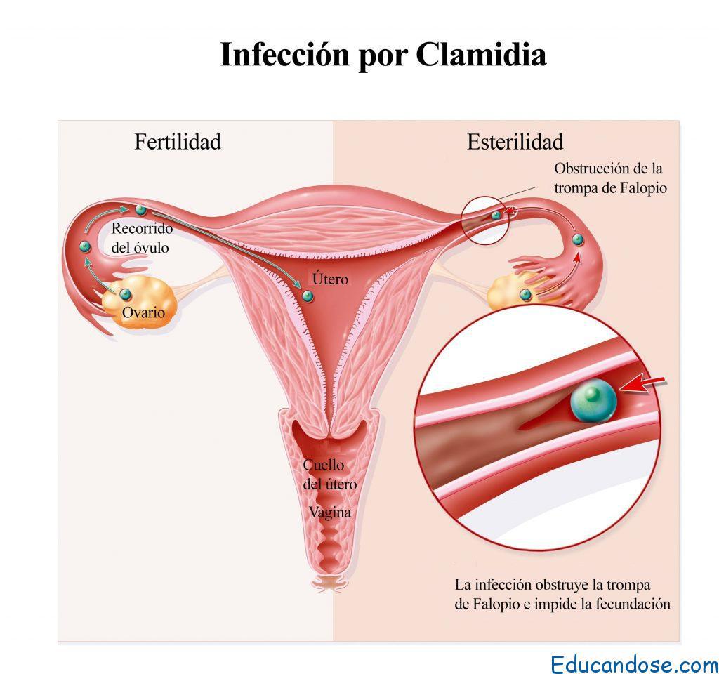 las verrugas genitales pueden causar micción frecuentes