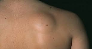 Obat Lipoma Obat Lipoma