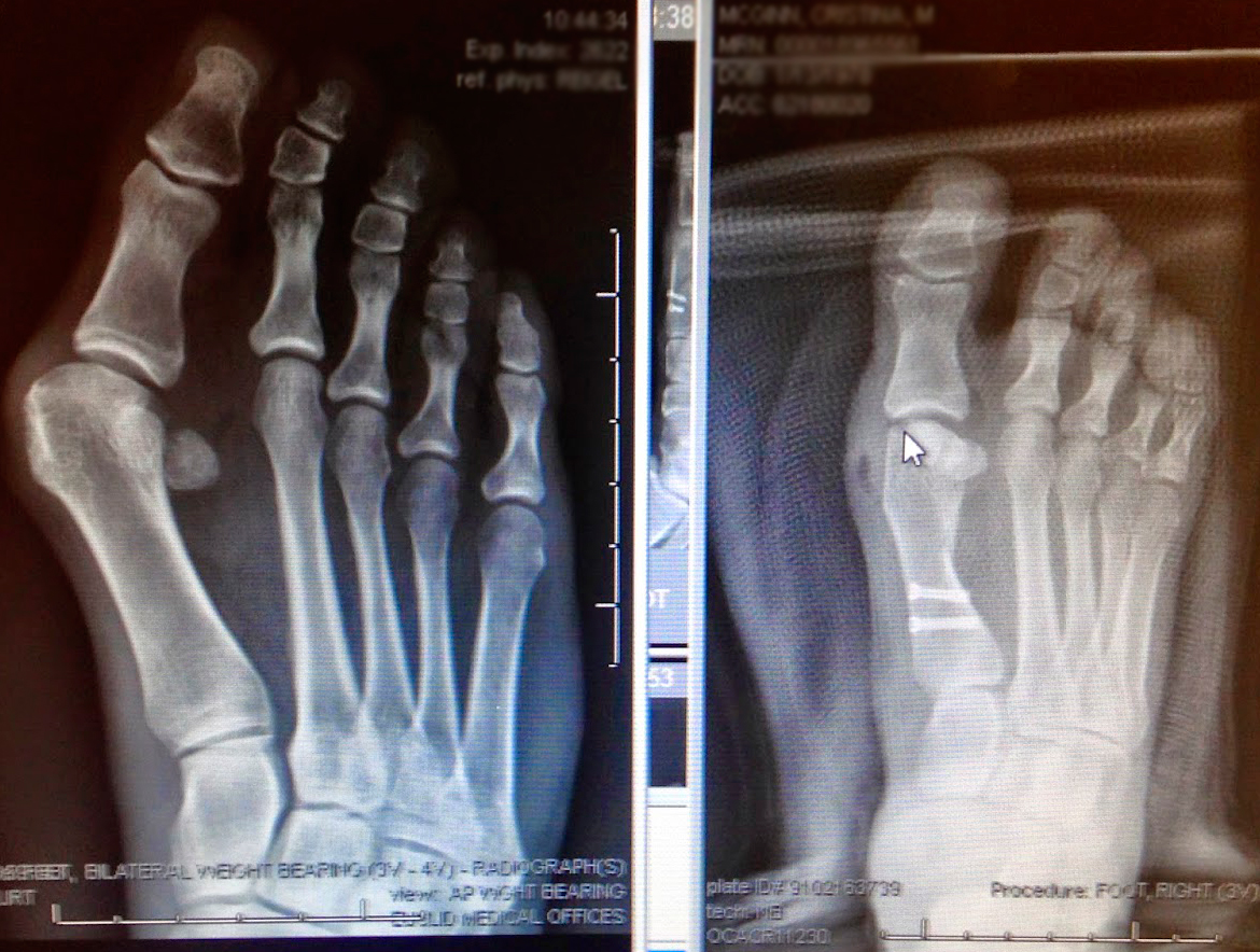 The Bloomin' Bunion Bunion Surgery & Recovery Blog Bunion Surgery
