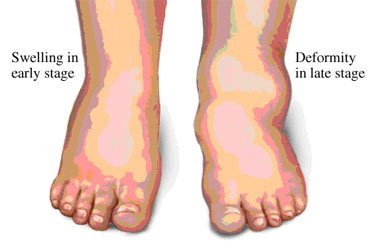 What Is Neuropathy