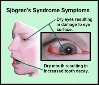 sjogrens-syndrome