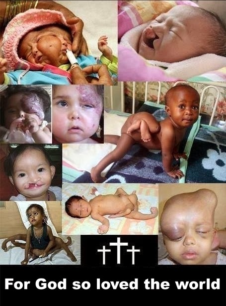 For God so loved the world picture - deformed suffering children