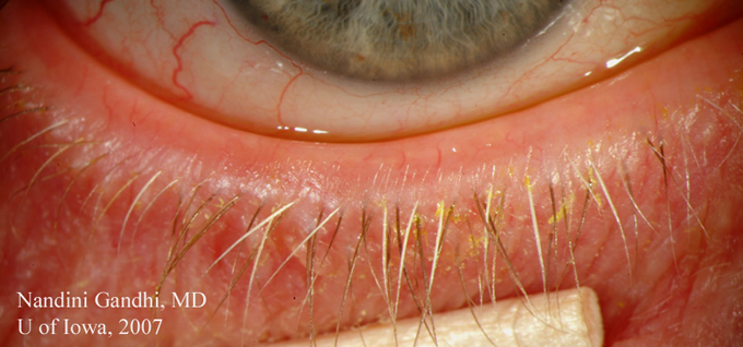 Eyelid contact dermatitis | DermNet New Zealand