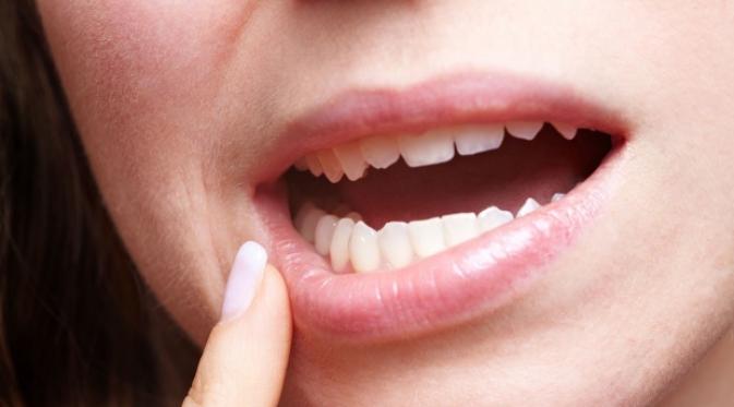 Mengatasi Sariawan Dengan Istirahat dan Konsumsi Makanan Bernutrisi