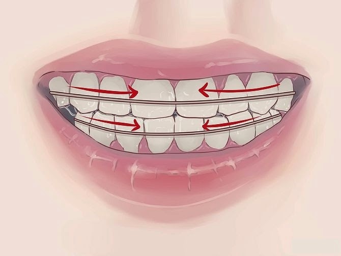 Redresser les dents sans bretelles