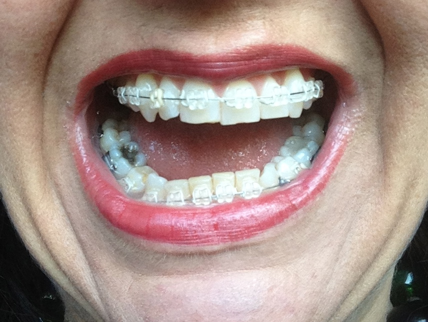 A Journey with my Teeth Broken Braces Wednesday 4th May 2016