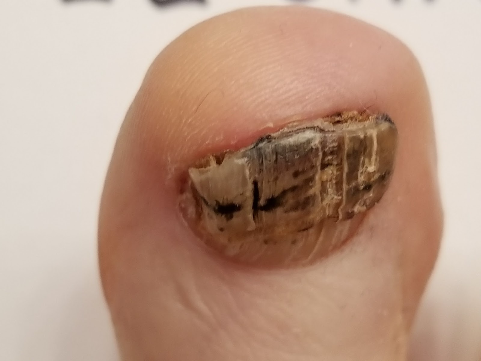 Run with Perseverance A Tale of Two Toenails; How to Fix Runner's Toenails