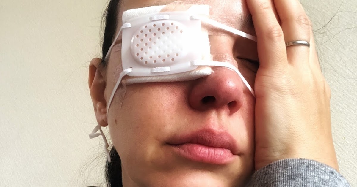 попала ворсинка в нлаз. попавшие в глаза предметы. попавшие в глаза предметы. попавшие в глаза предметы. ушибы (контузии) глазного яблока.