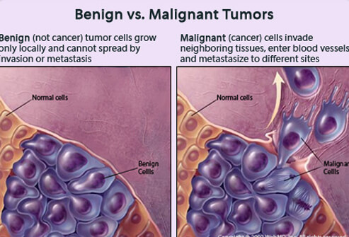 The Treatment Of A Malignant Tumor