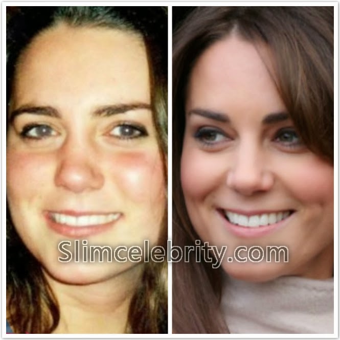 Kate Middleton Plastic Surgery Kate Middleton Plastic Surgery