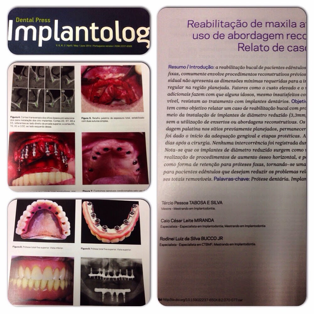 Rodinei Bucco 2014 ARTIGO PUBLICADO NA REVISTA DENTAL PRESS