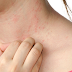Obat Tradisional Pereda Gatal Penyakit Herpes