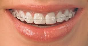 Ưu điểm của niềng răng không nhổ răng là gì?