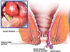 Foto Obat wasir bab berdarah ampuh