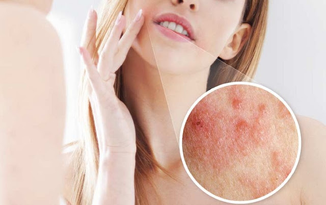 Obat Herbal Yang Bagus Untuk Menyembuhkan Penyakit Kulit http://khasiatmanfaatobatherbal.blogspot.com/2018/07/obat-herbal-yang-bagus-untuk.html